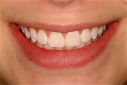 Bonding and White-Filling