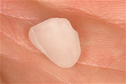 No Prep Porcelain Veneers