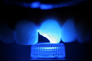 No Prep Porcelain Veneers